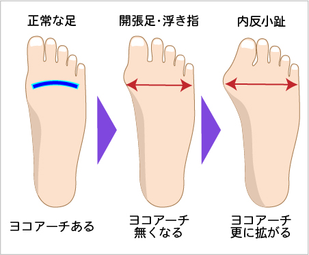 内反小趾の症状の進行
