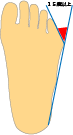 この角度が15度以上なら内反小趾の可能性が高い