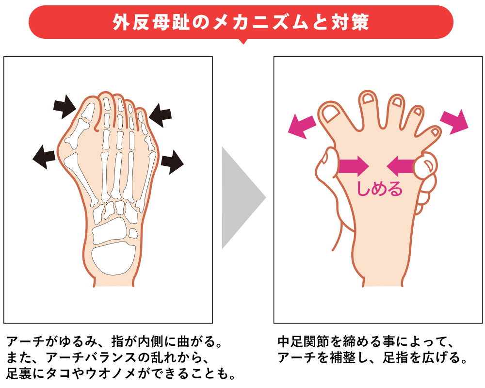 外反母趾のメカニズムと対策