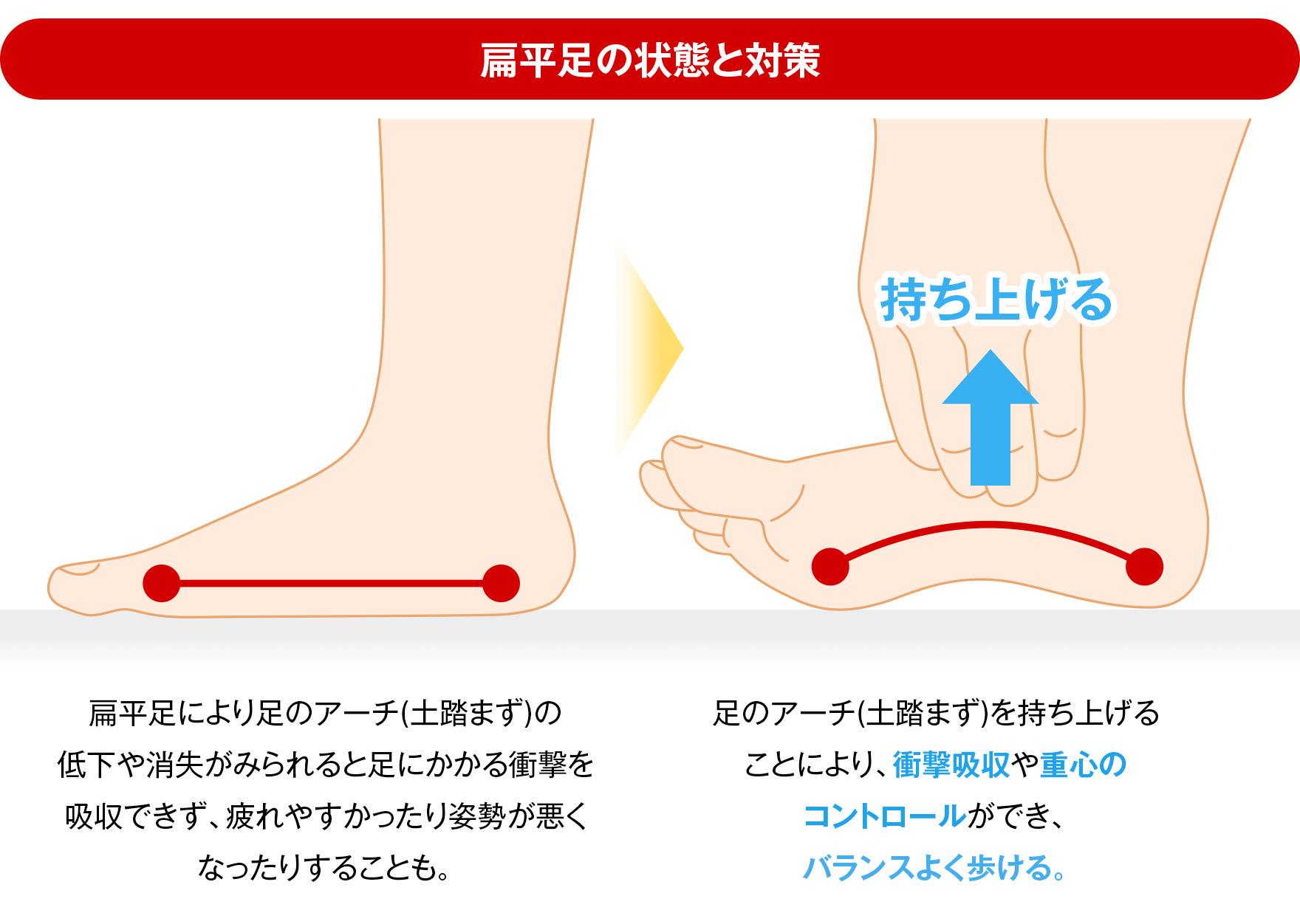 扁平足・ハイアーチだと何が良くないの？